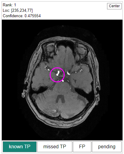 Lesion candidate classification